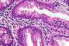 Großaufnahme einer Epithelzelle aus dem Darm mit Abetalipoproteinämie, auch Bassen-Kornzweig-Syndrom oder Akanthozytose genannt. Es handelt sich dabei um eine seltene Fettstoffwechselstörung. Foto: Von Nephron - Eigenes Werk, changes made; CC BY-SA 3.0, https://commons.wikimedia.org/w/index.php?curid=14815815